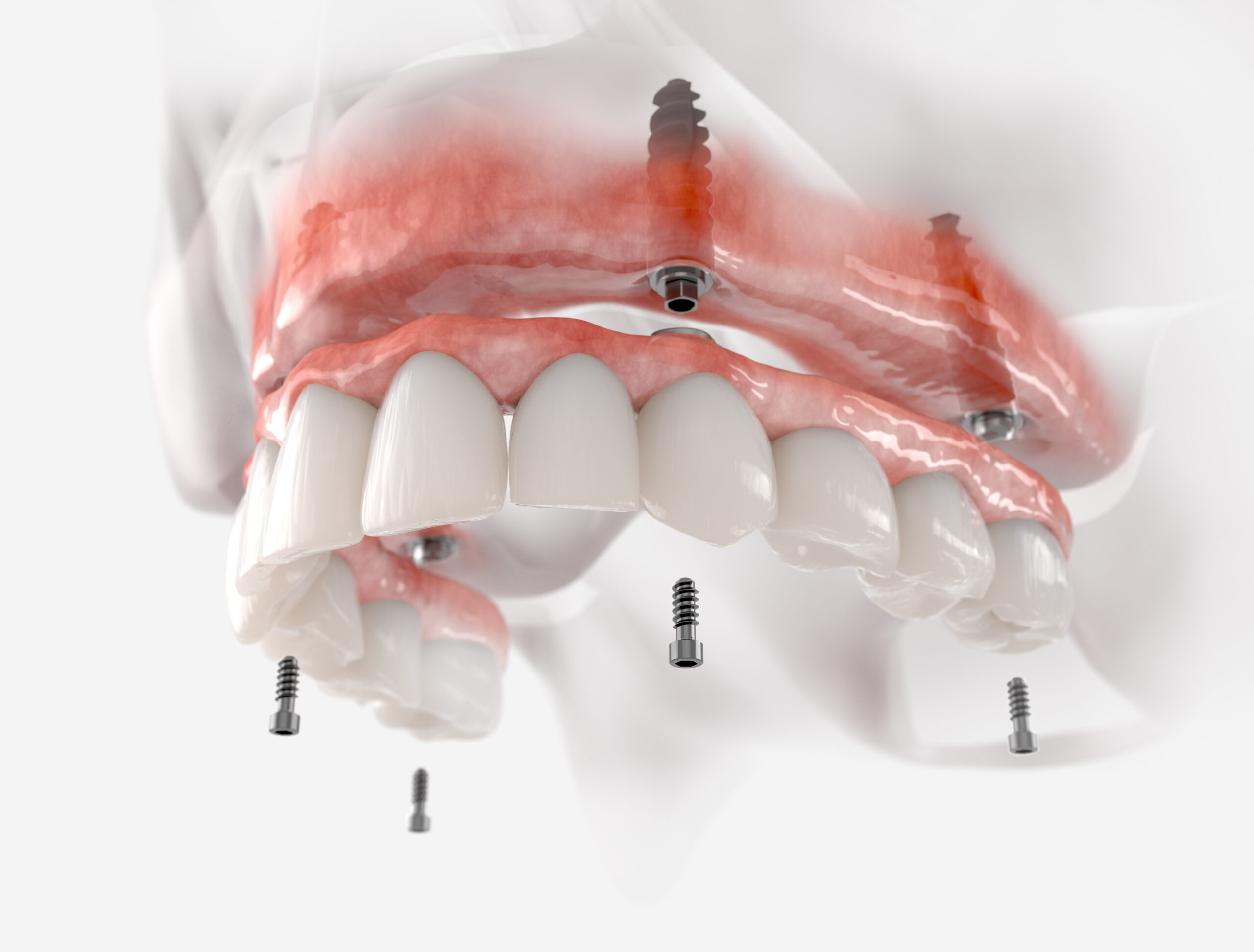 Maxillary fixed restoration with 4 implants. Realistic 3d illustration.